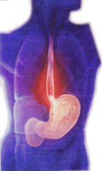 What Causes Heartburn? What Causes Heartburn?